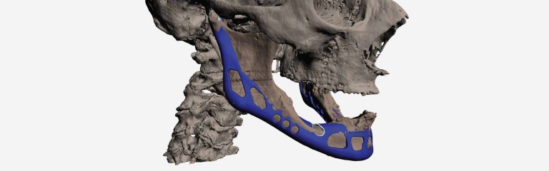 3D Printed Jaw Implant