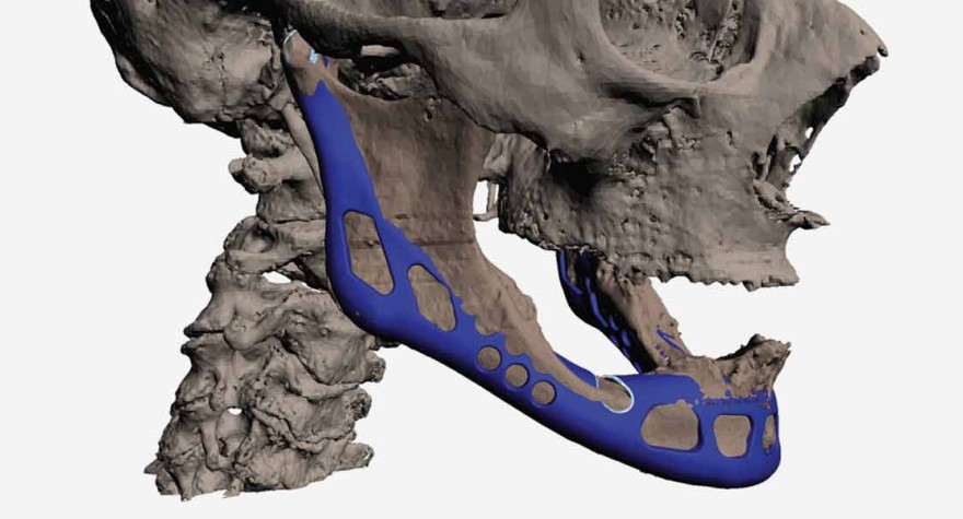 3D Printed Jaw Implant